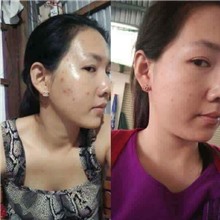 BỘ TRỊ MỤN ĐÔNG Y